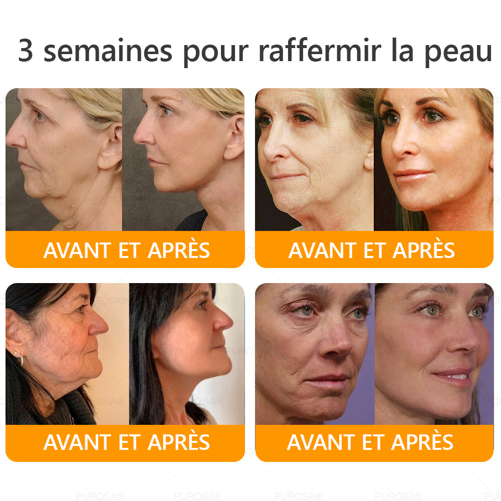 🐝PUROSA® Venin d'abeille  Crème de restauration de la peau🔥 DERNIÈRE JOURNÉE – 80 % DE RABAIS !